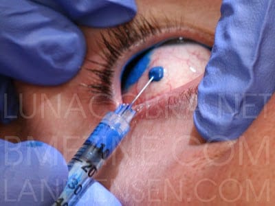 Everything You Need to Know About Eyelid Tattooing - Conlon Eye Institute